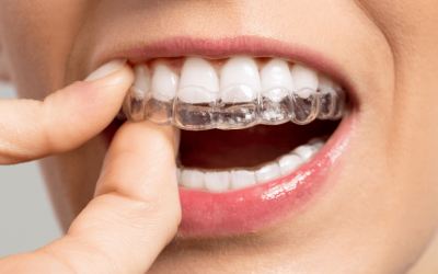 ¿Qué es y en qué consiste la ortodoncia invisible?