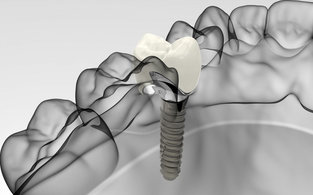 ¡5 ventajas de los implantes dentales!
